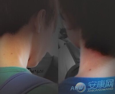 脖子上长痣面相图脖子上长痣好不好图文