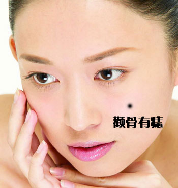 颧骨有痣疤痕纹的人好不好