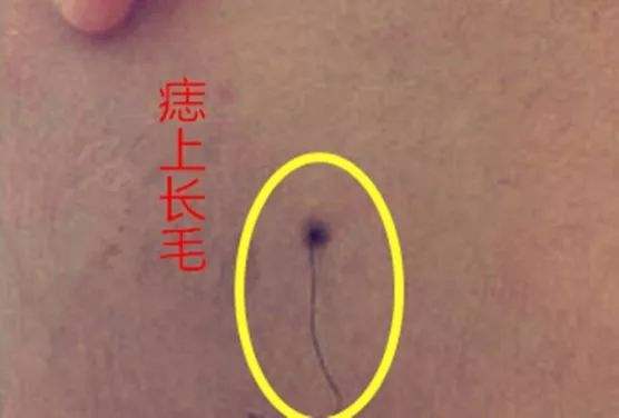 也就是可以说是一个吉痣,这些的痣,其实也是可以说明了就是富贵痣