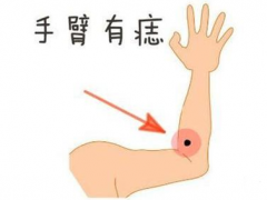 手背痣相图解-手上的痣预示什么