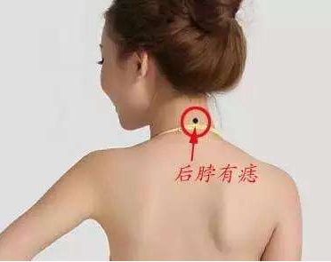 脖颈痣的位置与命运图_脖子的痣相解析