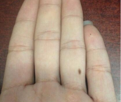 右手无名指有痣代表什么从痣的位置来看