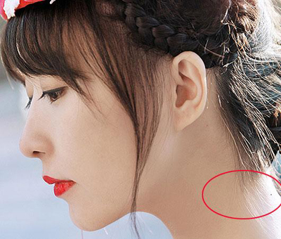 一个人脖子后面长痣是靠山痣还是苦情痣