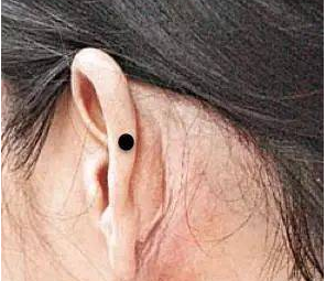 耳朵有痣图解耳朵有痣怎么样