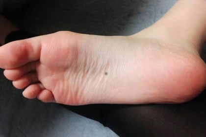 脚底有一颗痣怎么样好不好