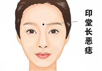 痣长在"女人美人尖"的印堂上:印堂在十二宫中属生命之宫,对人生很重要