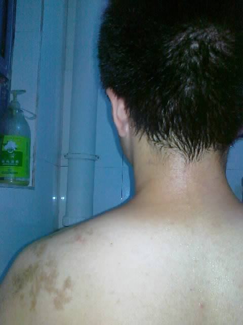 肩膀上的胎记预示着什么