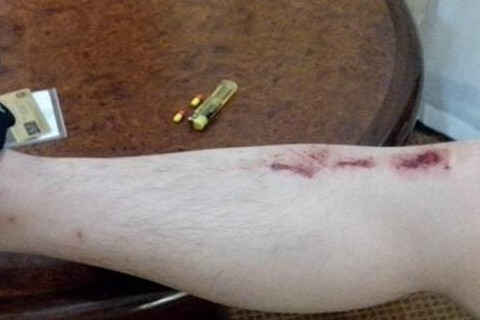 梦见自己脚受伤流血