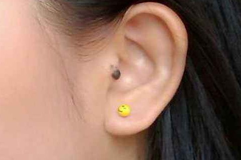 耳朵旁边的痣好不好