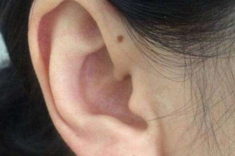 女人左耳朵有痣图片