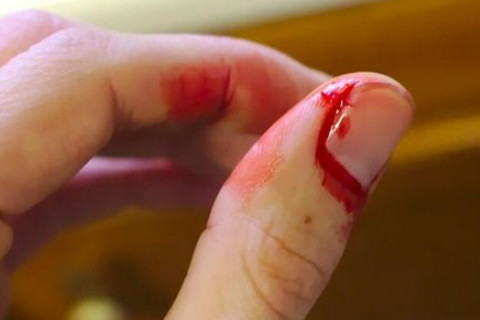 梦见手被割破流血了