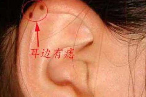 女人耳朵有痣图解大全