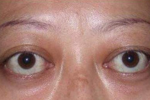 眼睛大而凸的女人面相怎么样