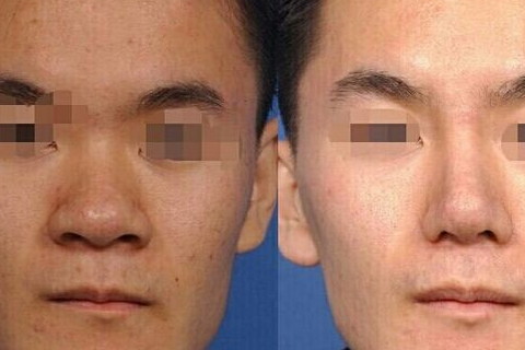 蒜头鼻的人面相如何