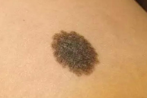 梦见痣变大