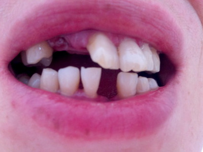 梦见掉一颗门牙