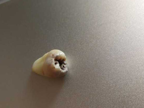 梦见拔掉一颗坏牙