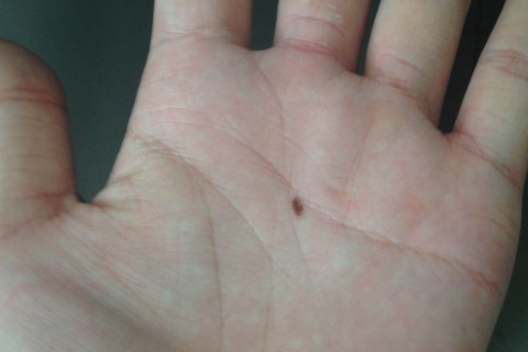 手掌有痣的男人代表什么意思 手掌痣的位置图解大全