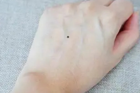 女生手上的痣的位置与命运图解 手上痣相图解2大福痣