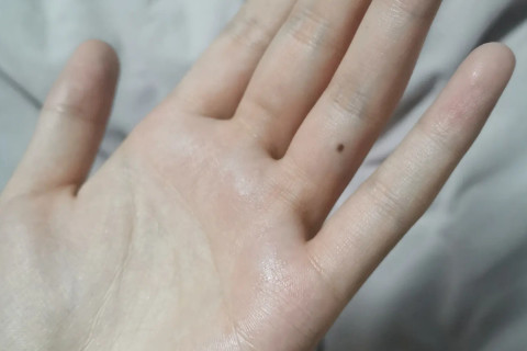 右手无名指有痣的女孩代表什么 无名指有痣代表什么意思