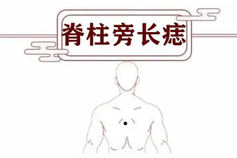 女人背上有痣图解左边 背上有痣的女人好不好