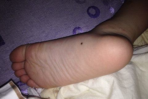 脚底有痣的男人代表什么 脚底有痣有什么说法